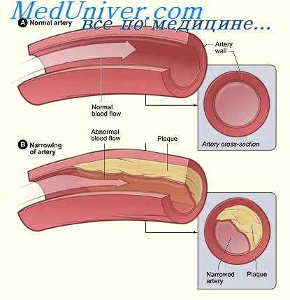 Epesav szekvesztránsok atherosclerosis