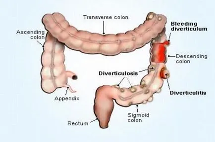 Tünetei és kezelése diverticulitis a szigmabél diéta, a népi és a hagyományos média