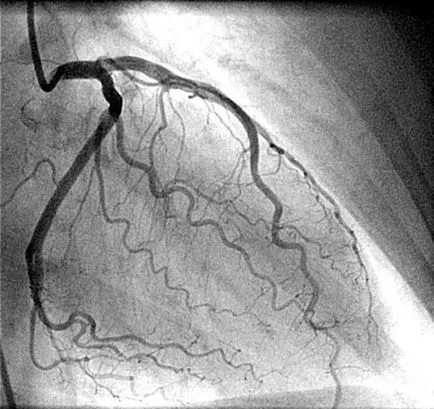 Heart by-pass chirurgie vasculara-data privire la perspectivele și riscurile