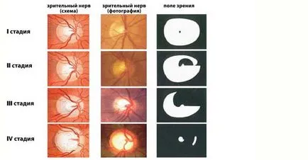 Metode moderne de tratare a atrofie parțială și completă a nervului optic în străinătate - clinici și