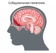 hematom subdural, este un tratament, consecințe