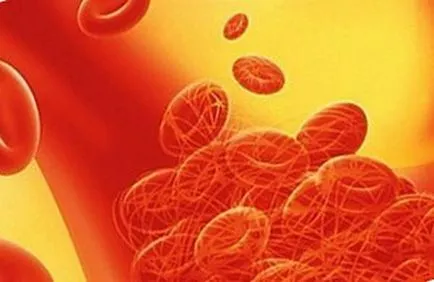 Thrombocytopeniás purpura gyermekek más típusú purpura és kezelésük