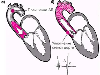 Seal aorta szív milyen, az okok és diagnosztizálás és röntgen átvilágítás