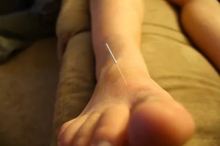 acupunctura chineză antică puncte puncte de aducțiune pe corp