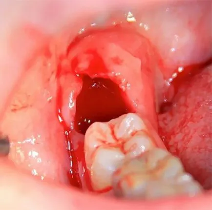 Мъдростта зъб извади колко ще боли да се направи, стоматология