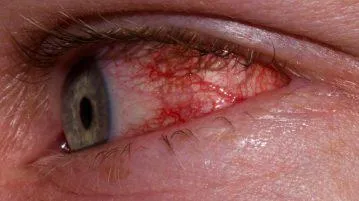 inflamație oculară, roșeață, tratament la domiciliu, cauzele pleoapelor corneei, superioare și inferioare