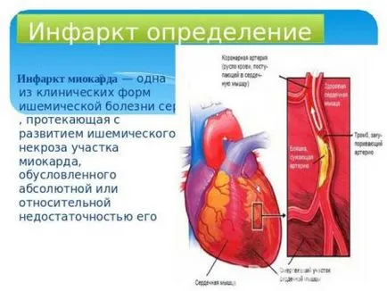 Възстановяване след инфаркт при възрастни