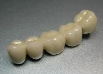 Coroanele dentare de metalloplastmassy