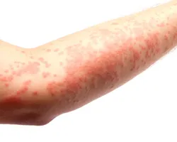 Az atópiás dermatitis - okai, tünetei, diagnózisa, kezelése