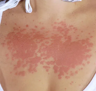 Алергия към слънцето - симптоми и лечение