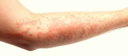 Алергия на ръка, под формата на червени петна и сърбеж как да се отнасяме