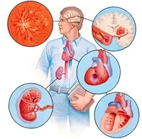Hipertensiune arterială - cauze, simptome, diagnostic și tratament