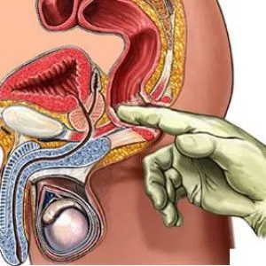 Atonia tratament prostata