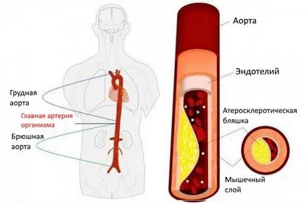 Ateroscleroza a abdominale (departamentul abdominale) al simptomelor aortă și tratamentul