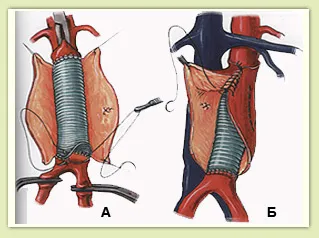 Tratamentul endovascular al anevrismelor aortice