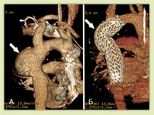 Tratamentul endovascular al anevrismelor aortice