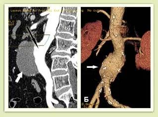 Tratamentul endovascular al anevrismelor aortice