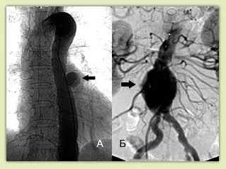 Tratamentul endovascular al anevrismelor aortice