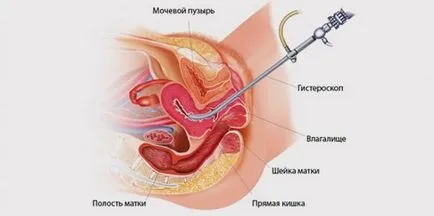 Долна коремна болка след кюретаж