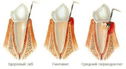 Венците, отколкото да се лекува у дома