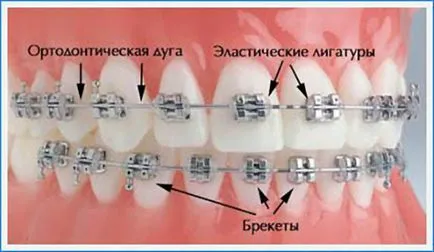 Скоби на разходите и монтаж - тип скоба системи, как да се сложи и как да се носят