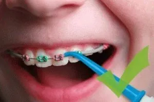 Миене на зъбите с тиранти и правилна грижа на системата за скоба