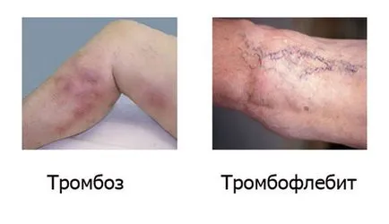 A trombózis jellemzi thrombophlebitis - sajátosságait és okait