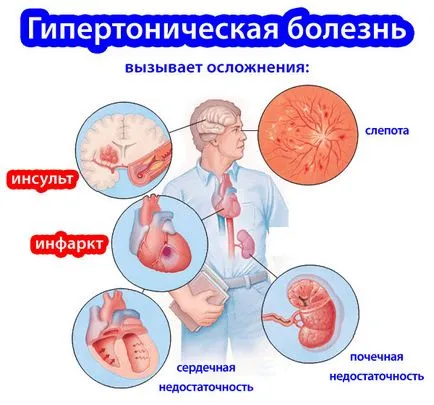 Чесънът хипертония (повишено налягане) - народен лек, мляко, лимон, дали има