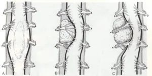 Ce este un lipom neuroma și a coloanei vertebrale lombare, simptomele