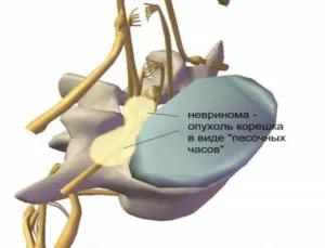 Ce este un lipom neuroma și a coloanei vertebrale lombare, simptomele