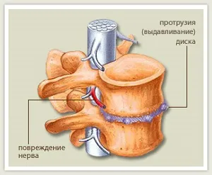 Care este proeminenței de simptome și tratament, diferența de hernie