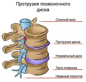 Care este proeminenței de simptome și tratament, diferența de hernie