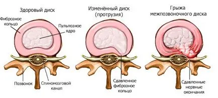 Care este proeminenței de simptome și tratament, diferența de hernie