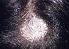 Pecingine tratamentului șef al infecțiilor fungice ale scalpului, simptome, fotografii
