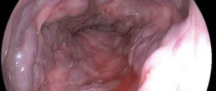 Dysphagia oesophagealis tünetek és a kezelés