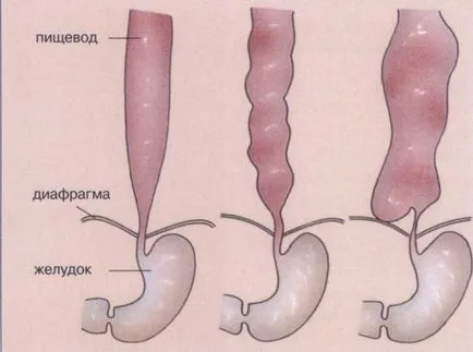 Dysphagia oesophagealis tünetek és a kezelés