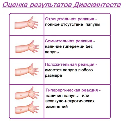 Diaskintest оценка на резултатите