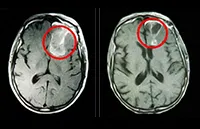 Доброкачествените тумори на мозъка причини, симптоми и лечение