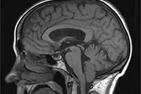 Доброкачествените тумори на мозъка причини, симптоми и лечение