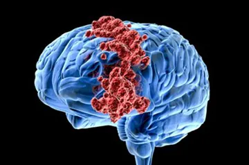 Jóindulatú agydaganat Causes, tünetek és kezelés