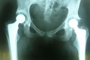 Kétirányú hip coxarthrosis