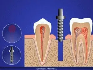 ratele de implantare Express pentru 2016 de la Moscova, o prezentare generală a clinici!