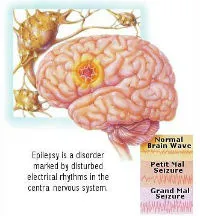 Epilepszia kezelésére, a tünetek, okok, tünetek, diagnózis