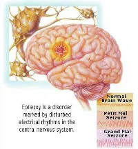Епилепсия лечение, симптоми, причини, симптоми, диагностика