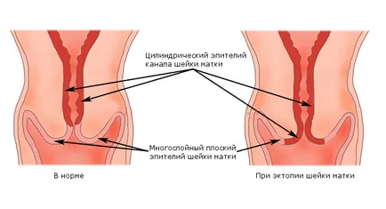 Eroziune cervicală după semne de naștere, metode de tratament