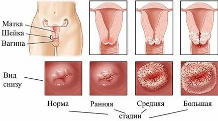 Eroziune cervicală după semne de naștere, metode de tratament