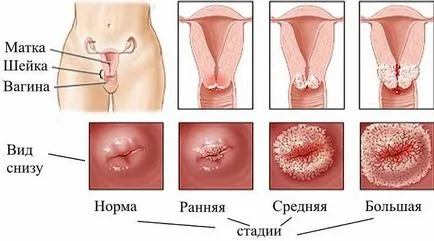 A méhnyak erózió születés után jelei, kezelési eljárásokat