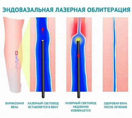 Endovasal (endovenoasă) obliterarea venelor cu laser raspunsuri (EVLO), în special proceduri