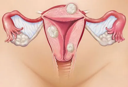 Fibromatoza a uterului ca o boală periculoasă și consecințele sale