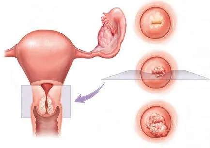 Fibromatoza a uterului ca o boală periculoasă și consecințele sale